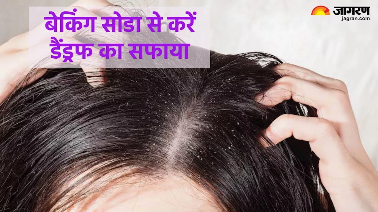 स्कैल्प पर जमी Dandruff की पपड़ी हटाने में बेकिंग सोडा है बेहद असरदार, इस्तेमाल से पहले जान लें ये जरूरी बातें