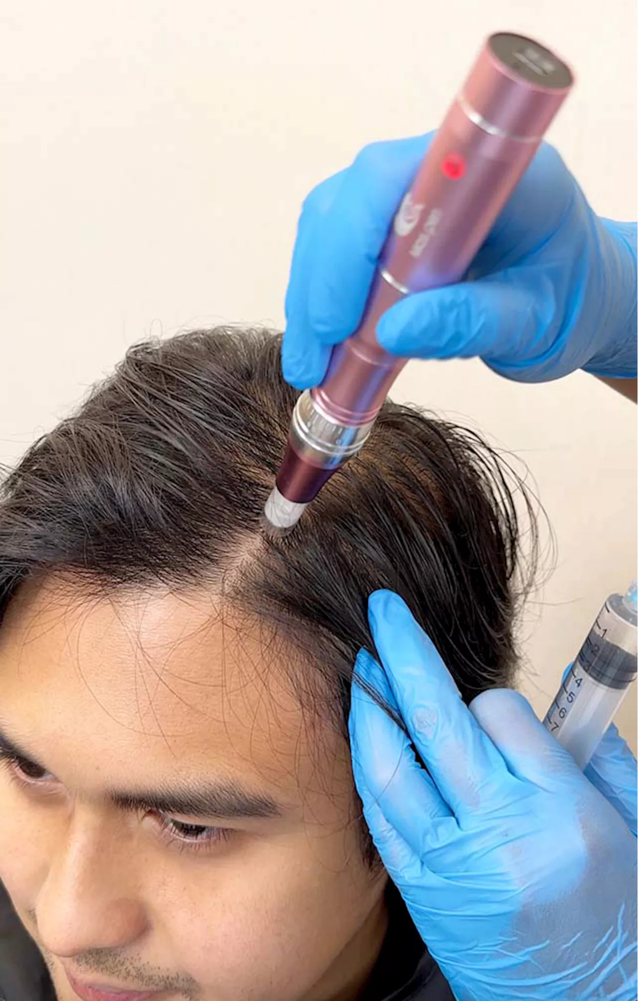 NexoHair is next-level hair and scalp intervention using exosomes