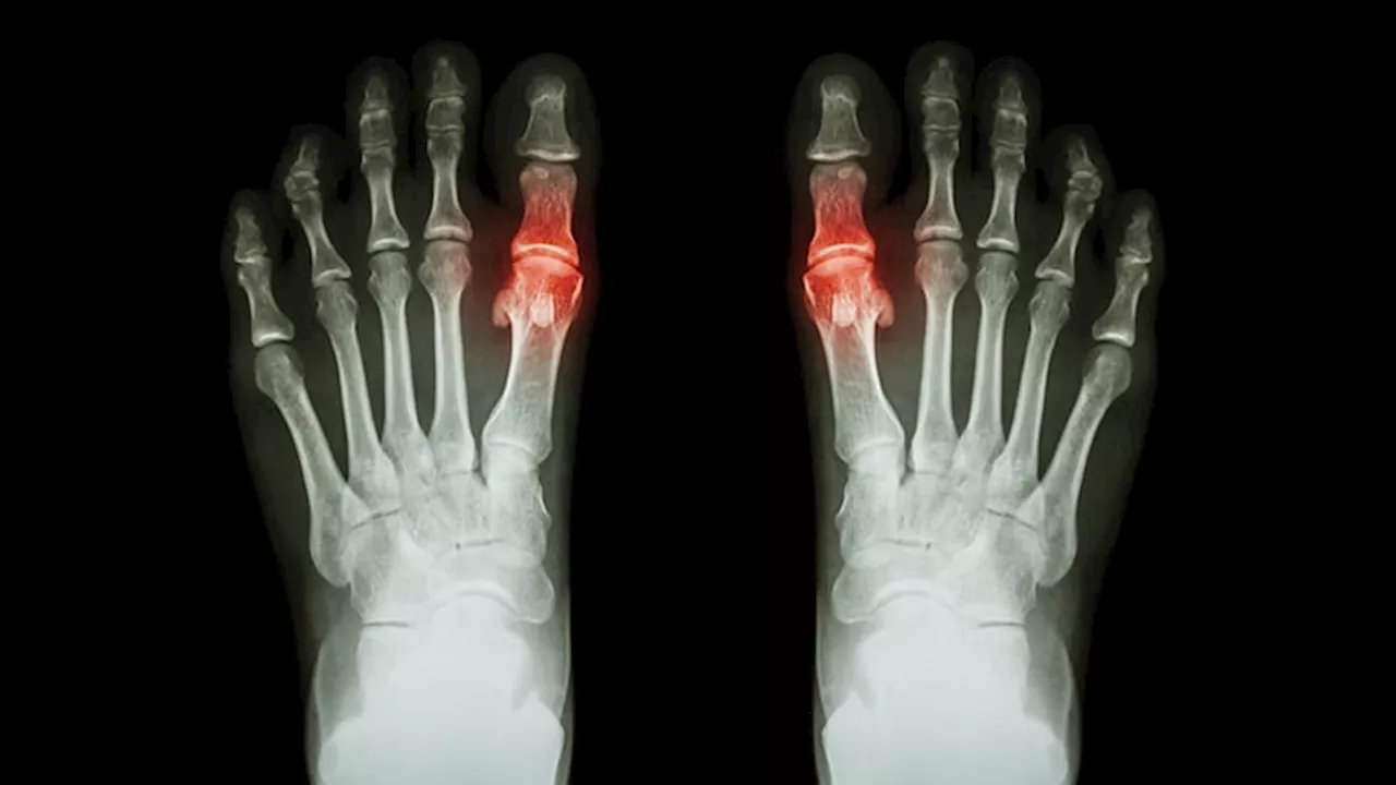 Nurse-Led Care for Gout Generates Best Uric Acid Control