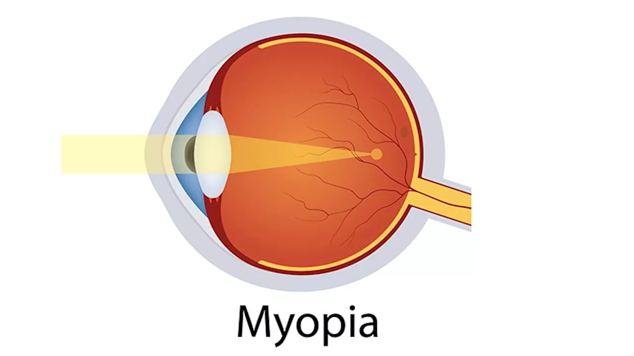 Repeated Low-Level Red Light Therapy Effective in Managing High Myopia in Children