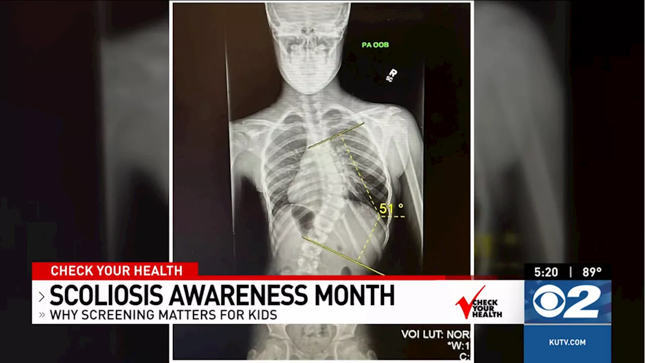 Khloee: Check Your Health- Scoliosis Awareness Month: Why Screening ...