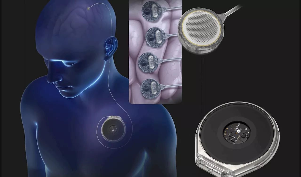 Neuralink competitor Paradromics gears up to test its brain implant on humans