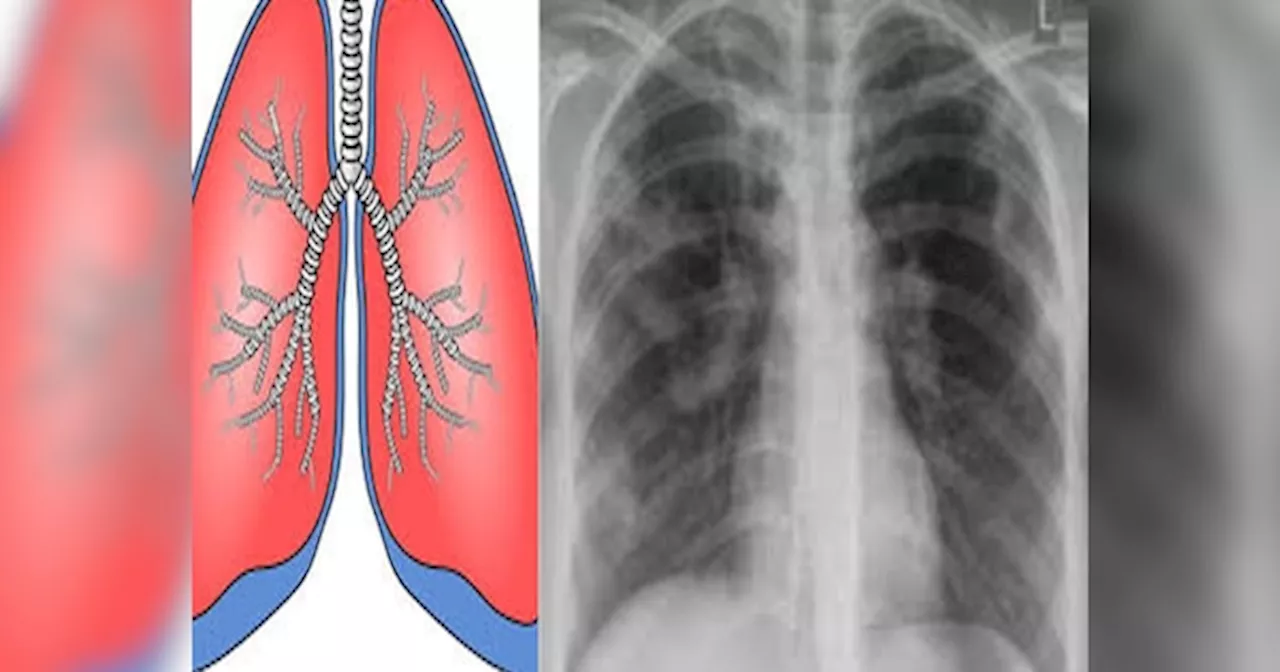 राजस्थान में यहां से TB बीमारी को लेकर सुखद खबर, जांच की संख्या बढ़ाने के बाद भी साल दर साल टीबी के मरीजों में हो रही कमी
