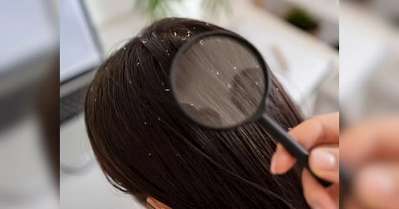 Dandruff Treatment: घर पर ही खत्म करें डैंड्रफ की समस्या, आजमाएं ये आसान घरेलू नुस्खे और दें बालों को नया जीवन