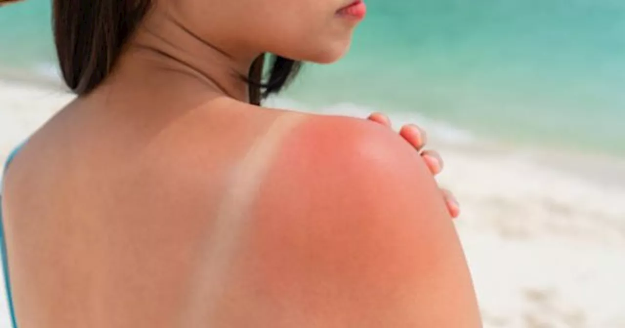 ¿Qué es un CALLO SOLAR y por qué debes DEJAR de tomar SOL todos los días?