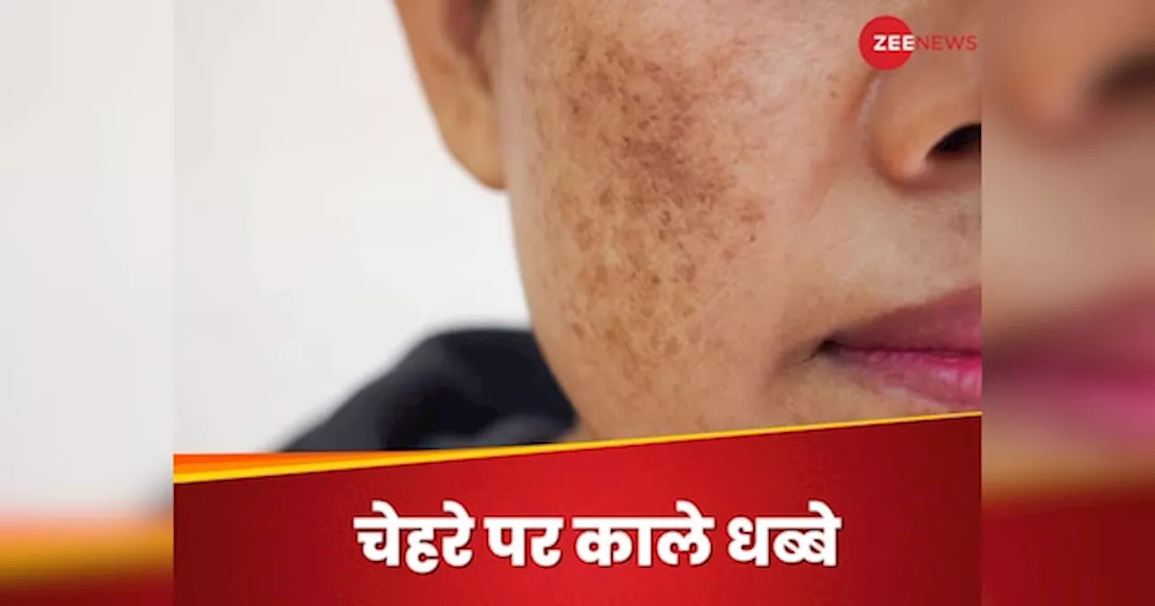 Dark Spots: चेहरे पर आते हैं काले धब्बे? तो रोकने के लिए तुरंत बदलें अपनी 4 आदतें