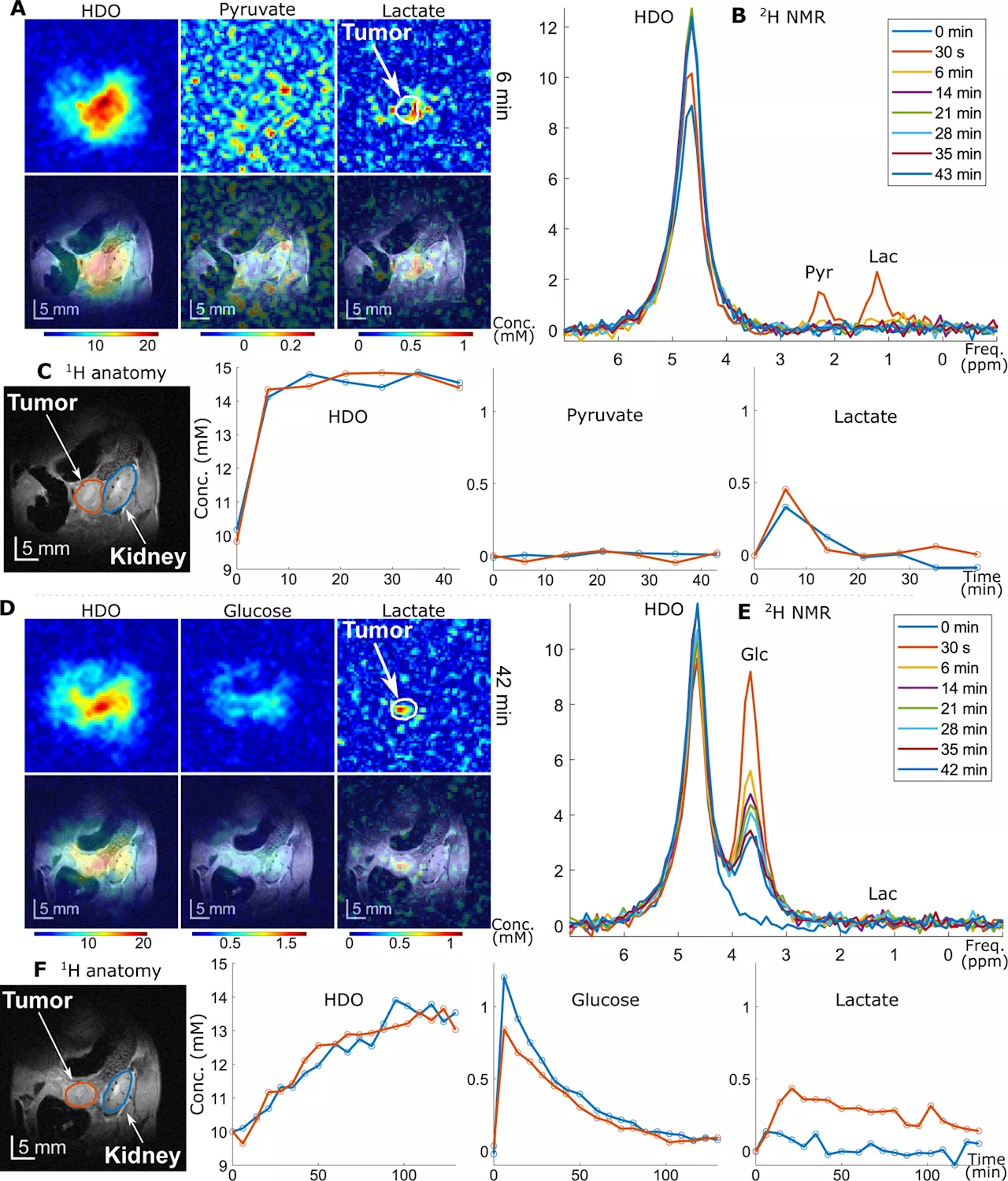 New MRI method uses altered glucose to 'light up' pancreatic cancer