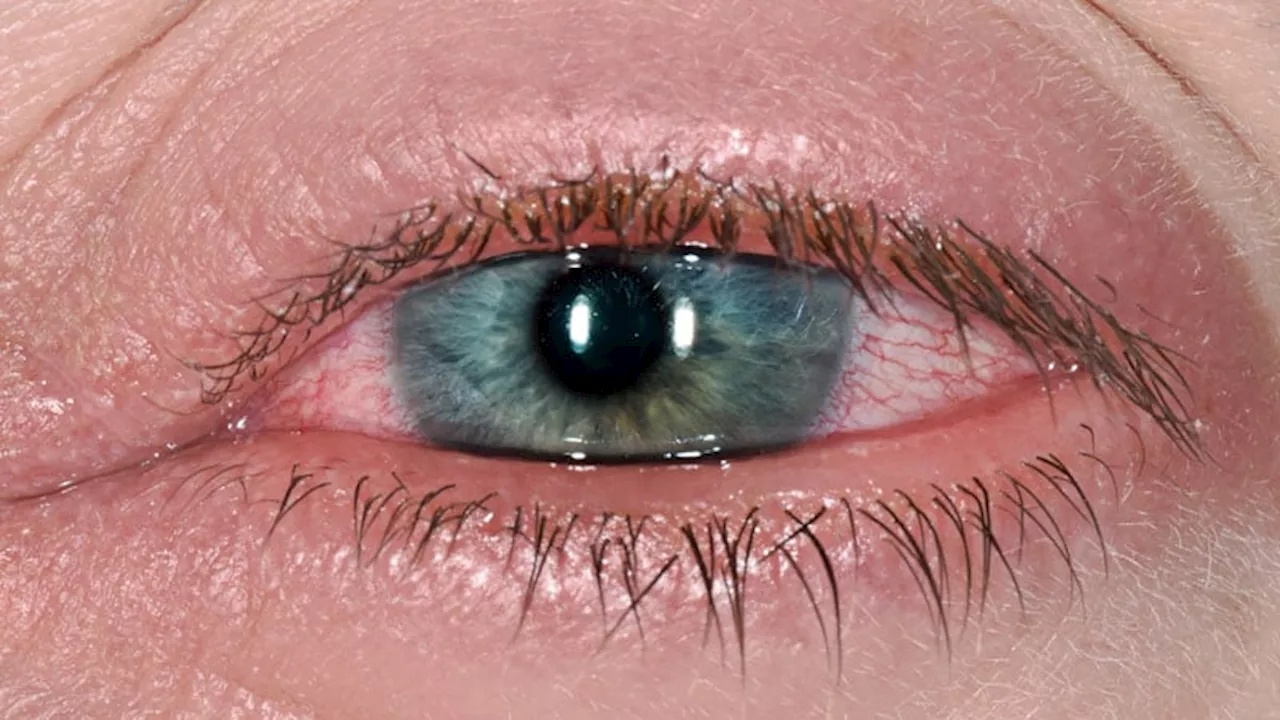 High Recurrence in Acute Uveitis Linked to Viral Causes