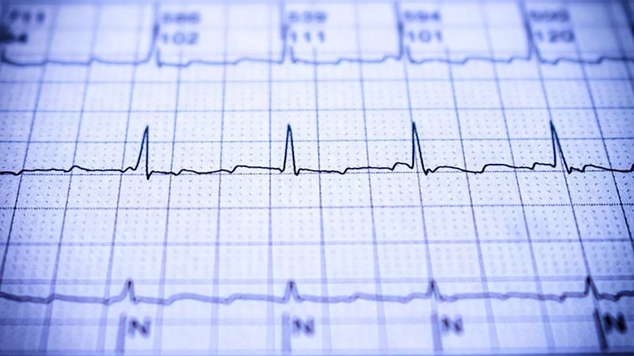 Honing Catheter Ablation Techniques for Atrial Fibrillation