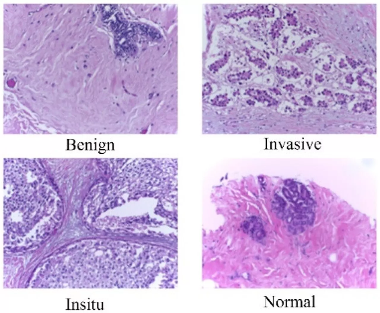 AI system diagnoses breast cancer with near 100% accuracy