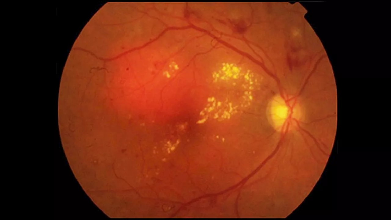 Faricimab Matches Aflibercept in Severe Diabetic Macular Edema