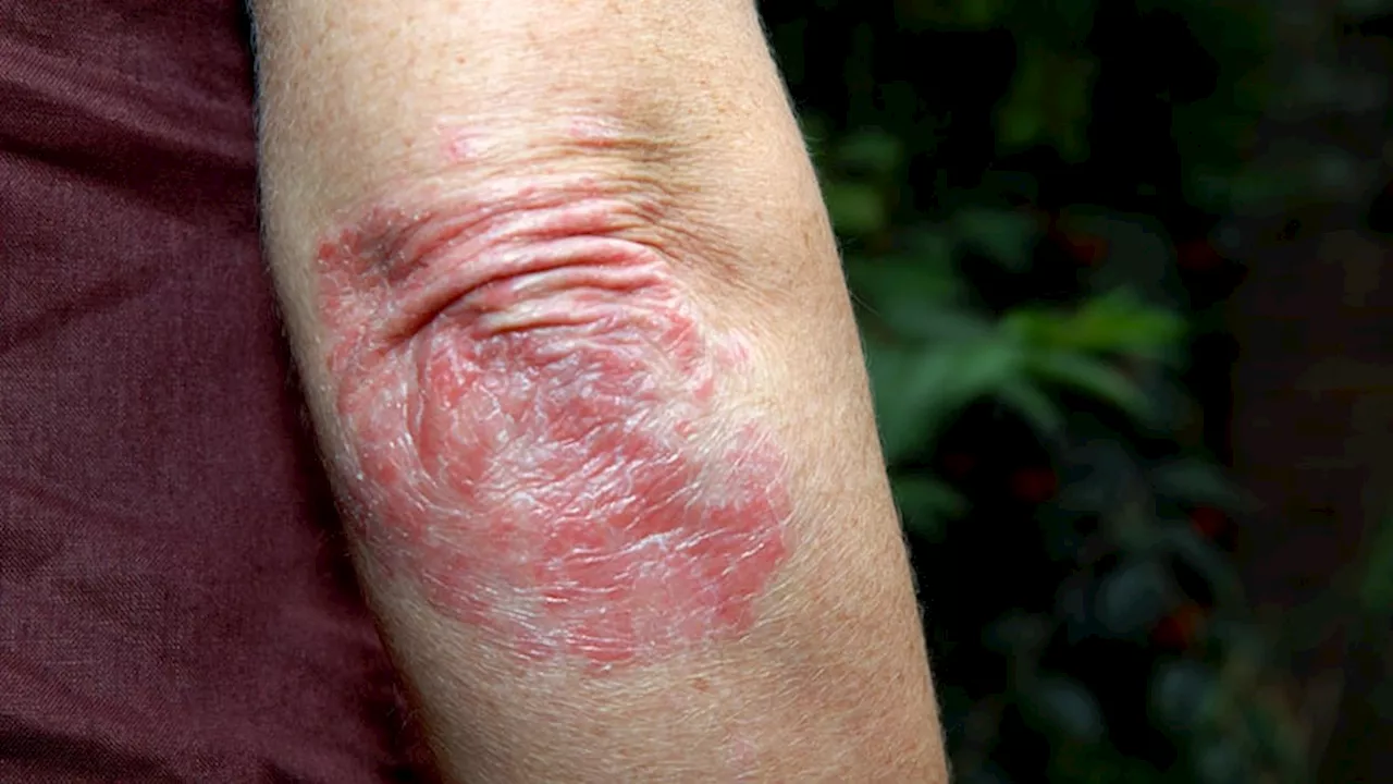 TYK2 Inhibitor Shows Early Promise in Psoriatic Arthritis