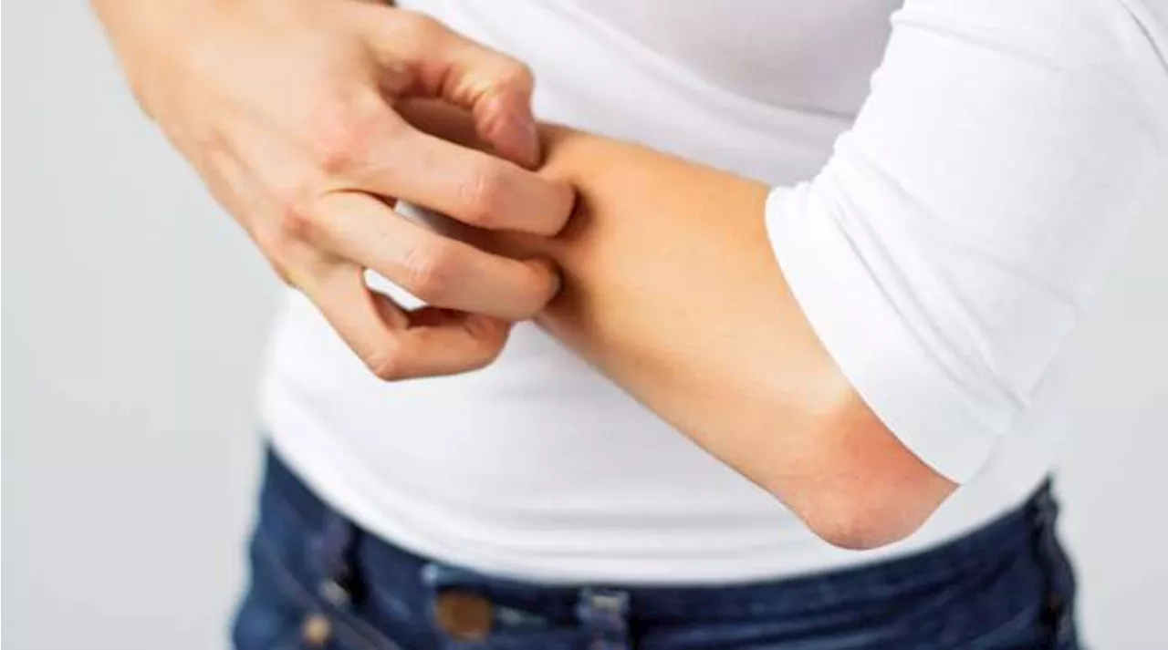 Mangiare troppo sale aumenta il rischio di eczema?