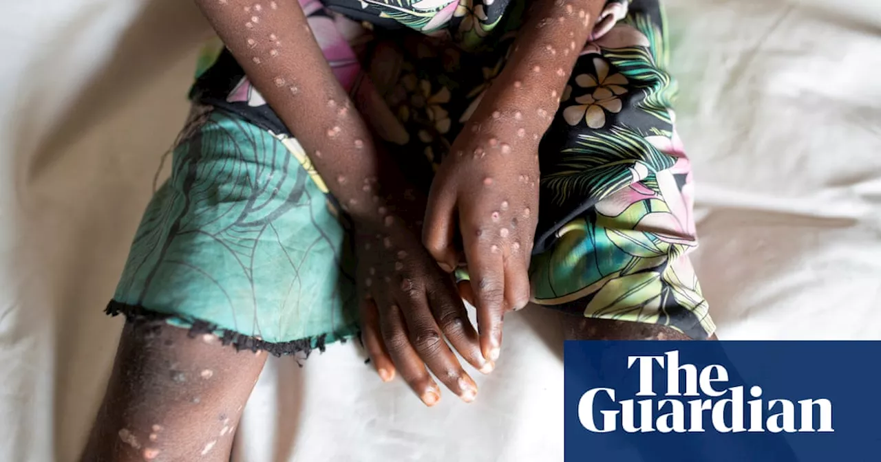 Warnings over lethal and contagious strain of mpox as children in DRC die