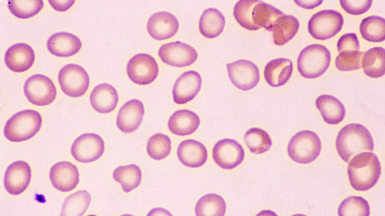 Most Cancer Patients Don't Receive Recommended Anemia Care