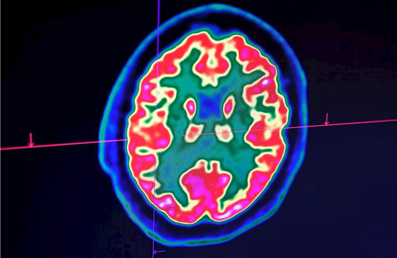 Scientists create AI model to ‘catch Alzheimer’s disease early’