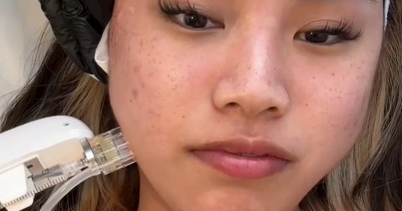 Woman tries 'salmon sperm' facial and it completely transforms her skin