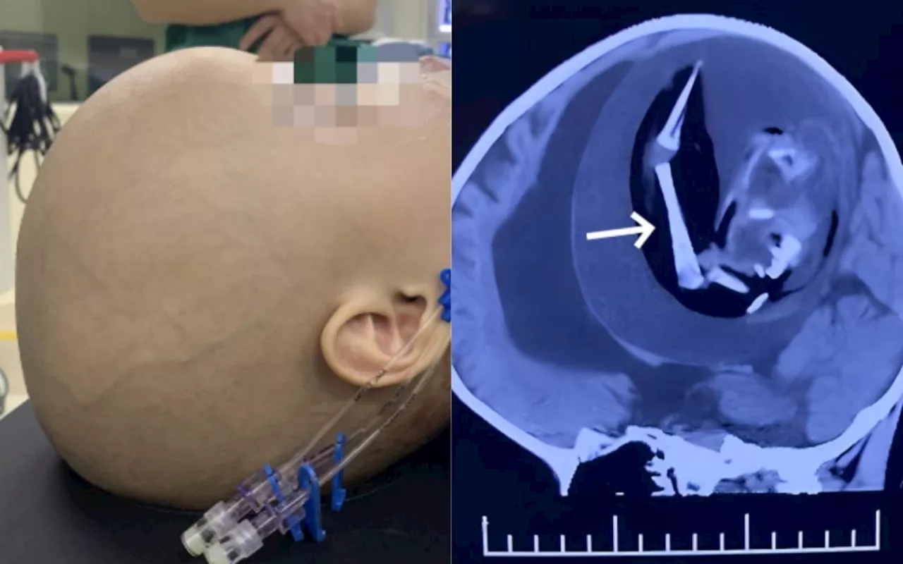 'Gêmeo parasita' com olhos, braços e cabelos é encontrado em crânio de bebê de 1 ano