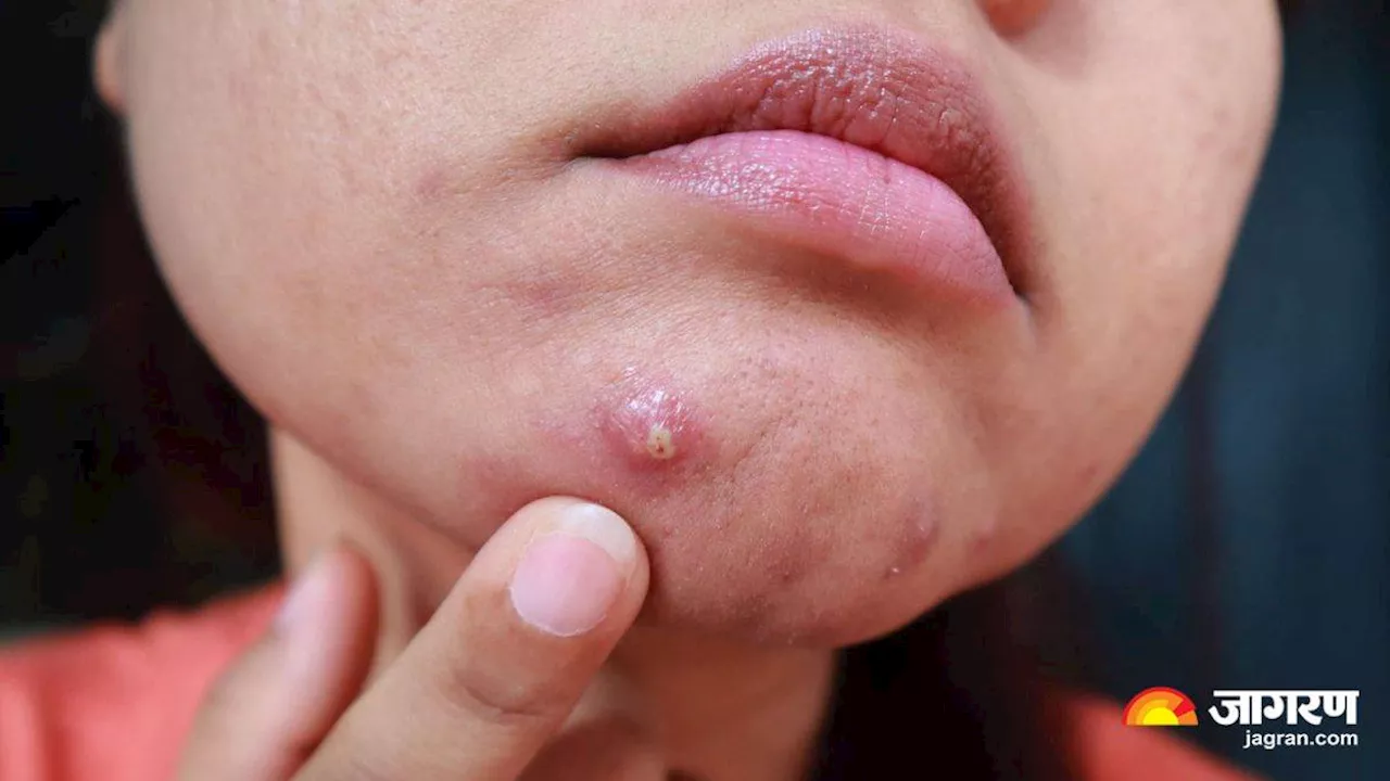 Acne Mistakes: मानसून में फोड़े-फुंसी से नहीं होना चाहते परेशान, तो आज ही कर लें इन 5 आदतों में बदलाव