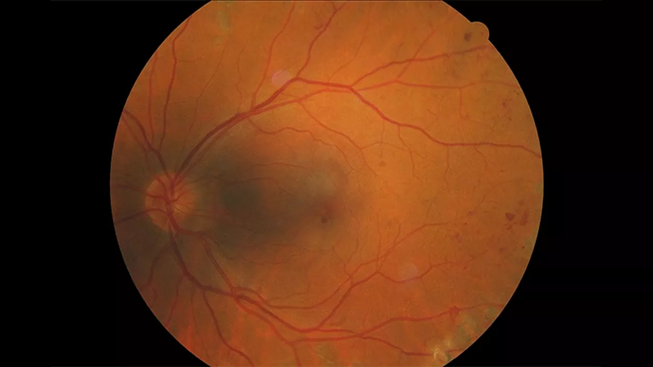 Rates of Diabetic Retinopathy Up Fivefold or More in Some Groups Over Past Decade