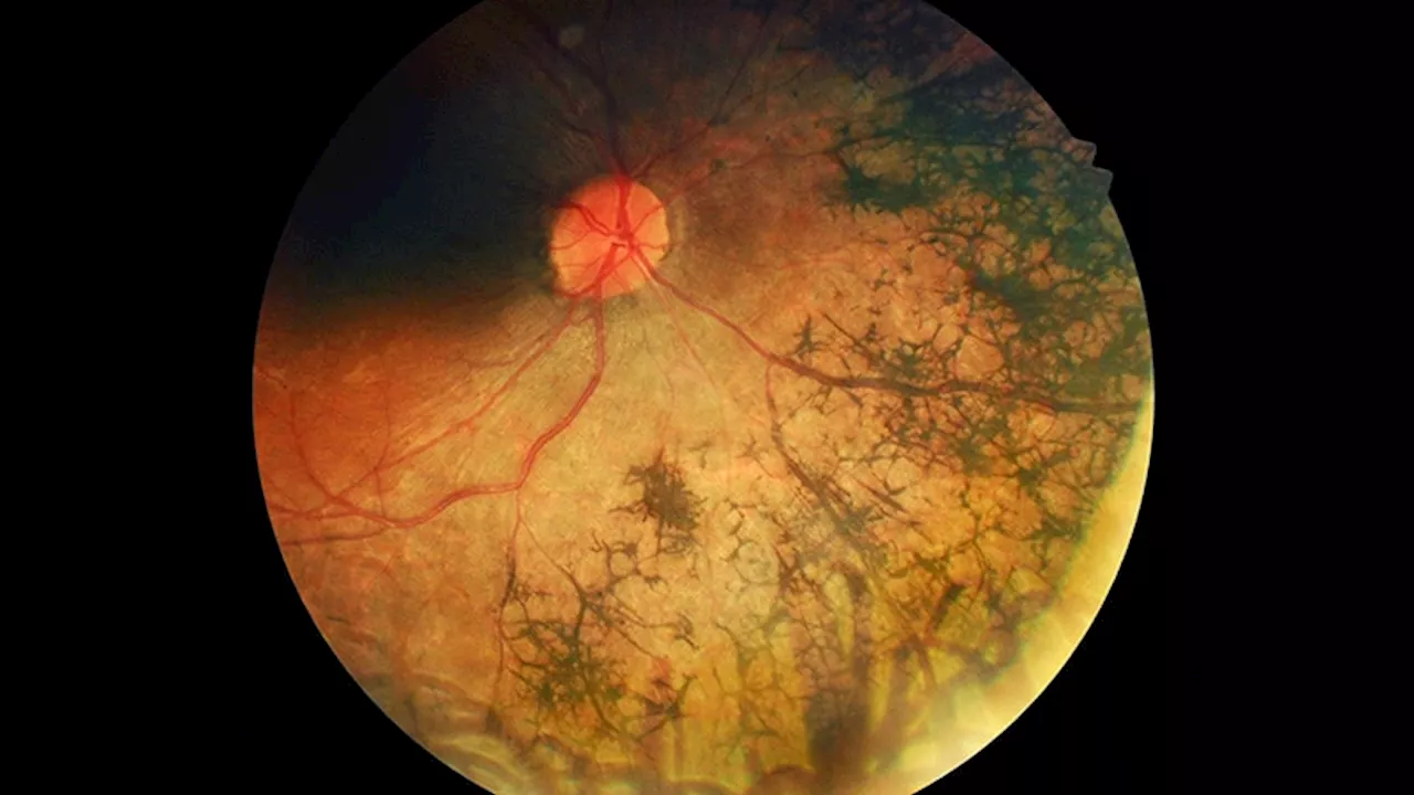 Retinitis Pigmentosa: 5 Things to Know