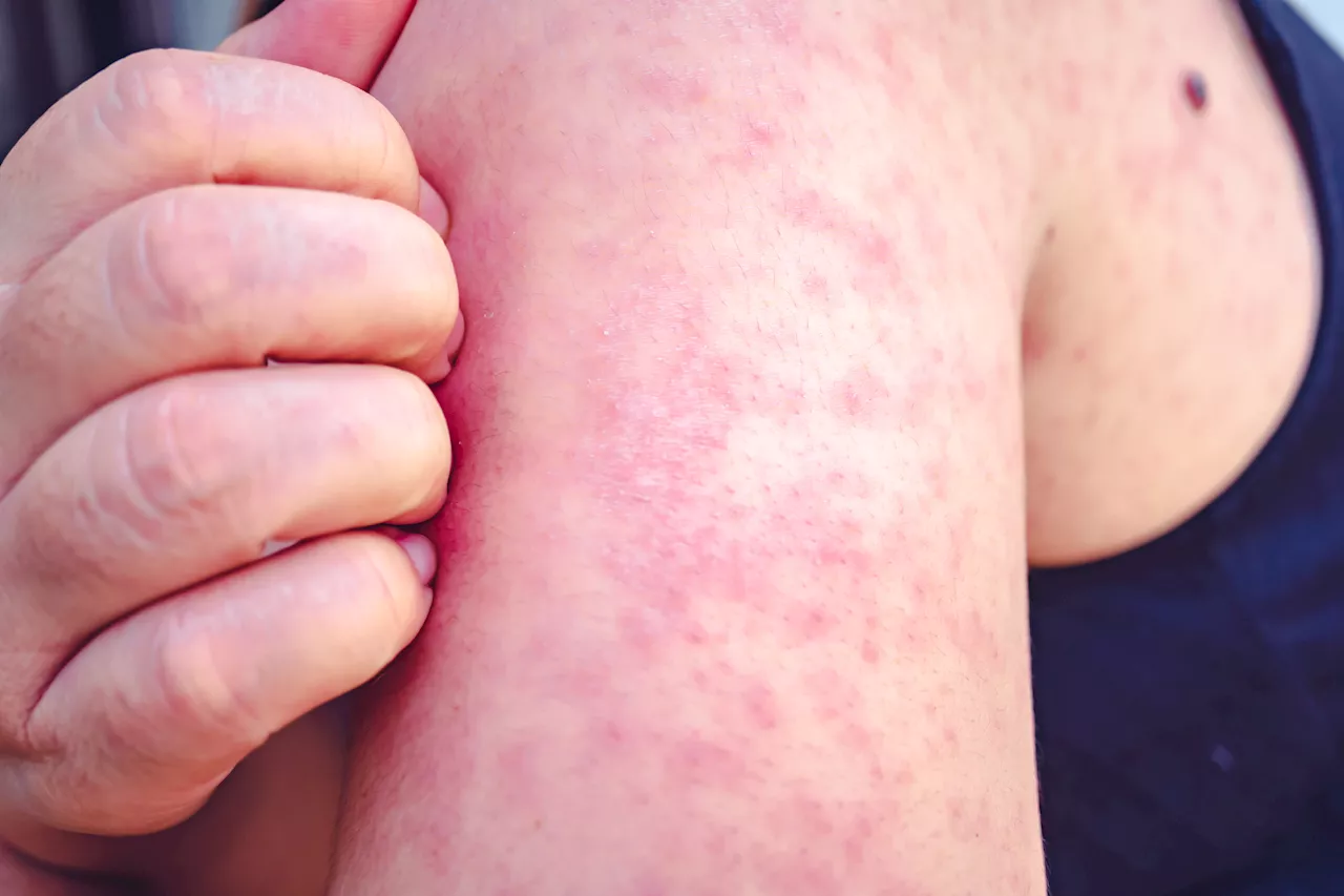 Health officials alert about potential exposure to measles in New Hampshire and Massachusetts