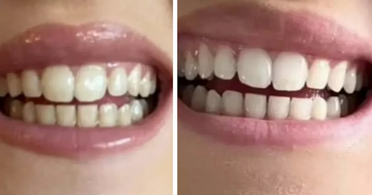 £1.50 teeth-whitening solution that works in 30 minutes