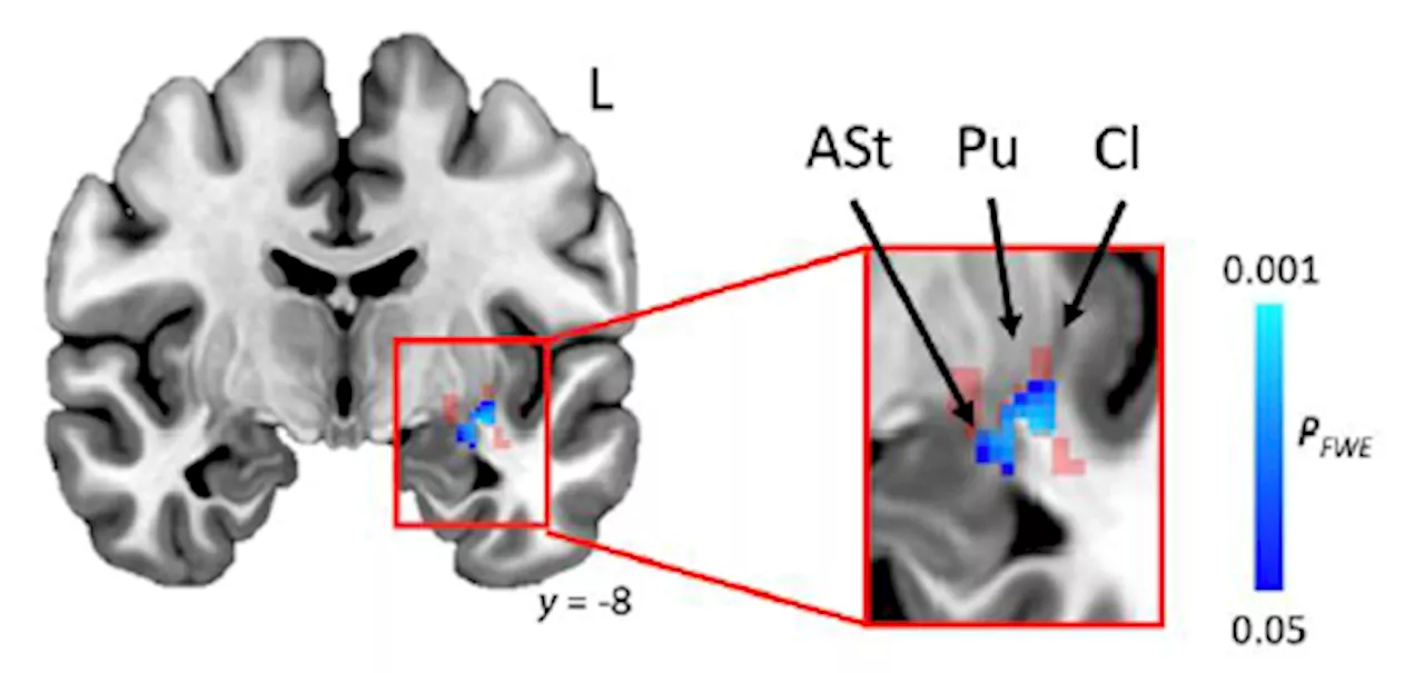 Scientists locate the source of stuttering in the brain