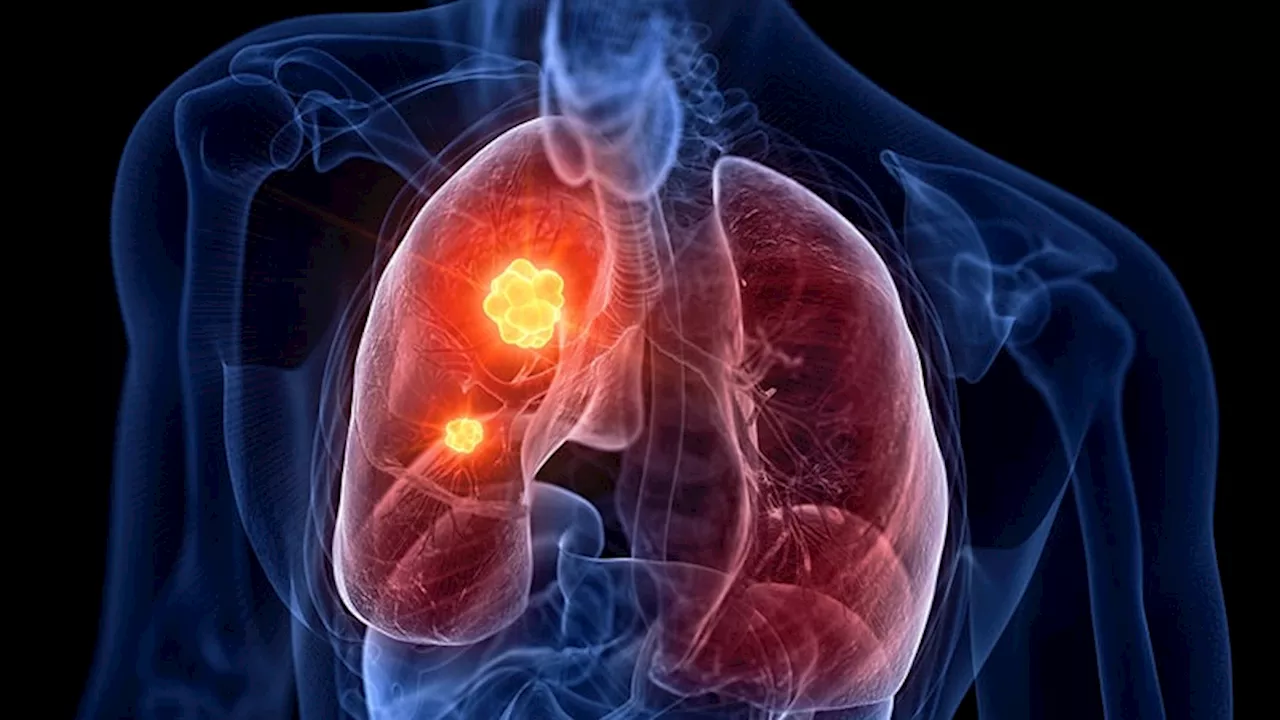 'Outstanding' Results for Osimertinib in Unresectable Stage III EGFR+ NSCLC