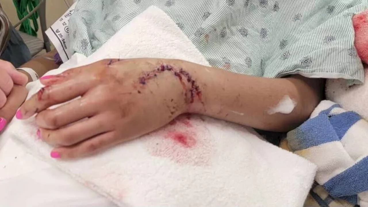 Shark bites 19-year-old at Galveston Beach, severed her tendons