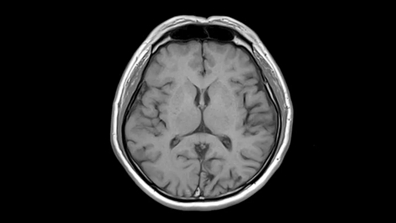 Multiple Sclerosis Med Nearly Eliminates Disease Activity on MRI