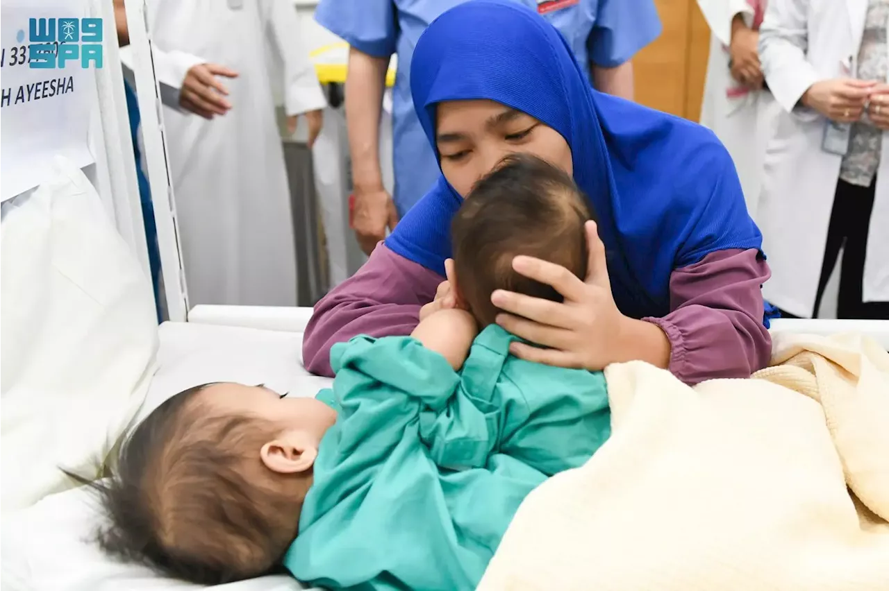 بدء عملية فصل التوأم السيامي الفلبيني أكيزا وعائشة على 5 مراحل