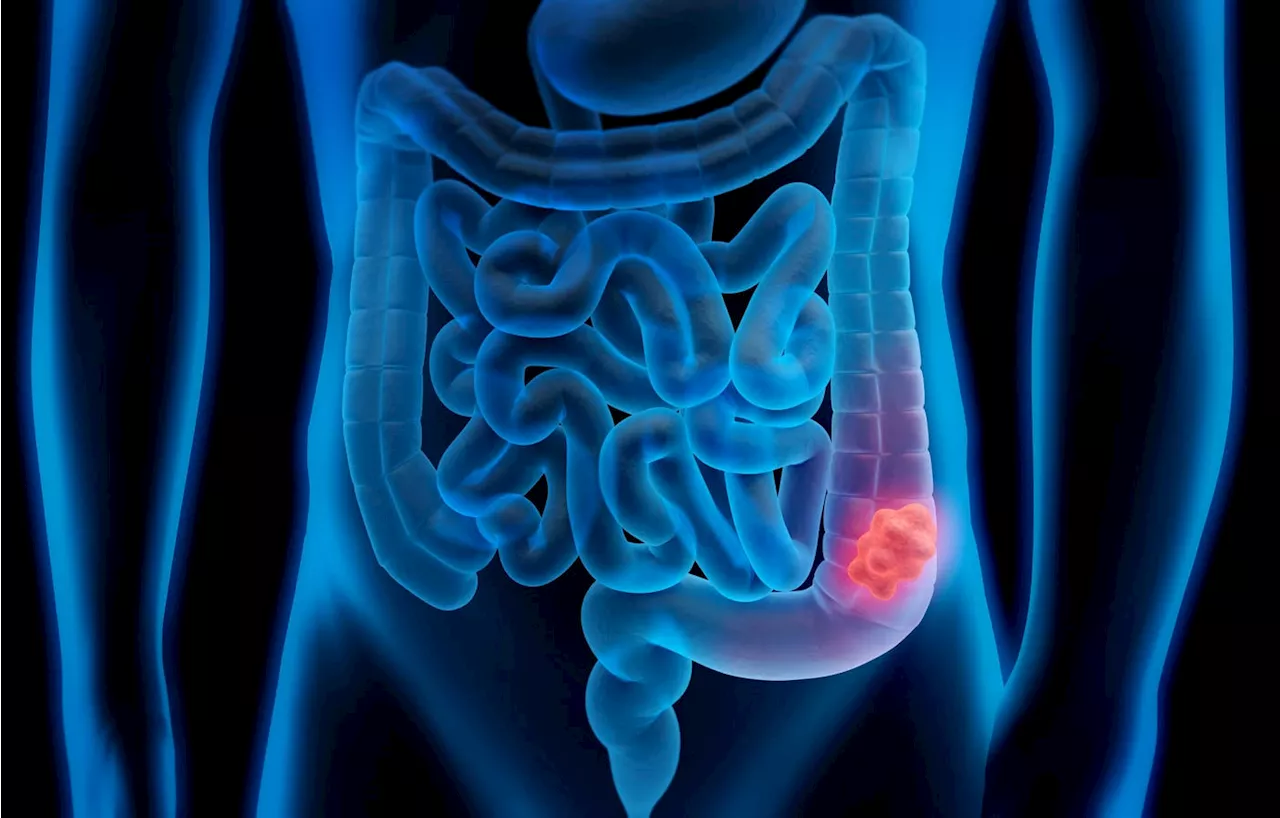 Phase 2 Study Shows Opdivo-Yervoy Highly Effective In Colon Cancer