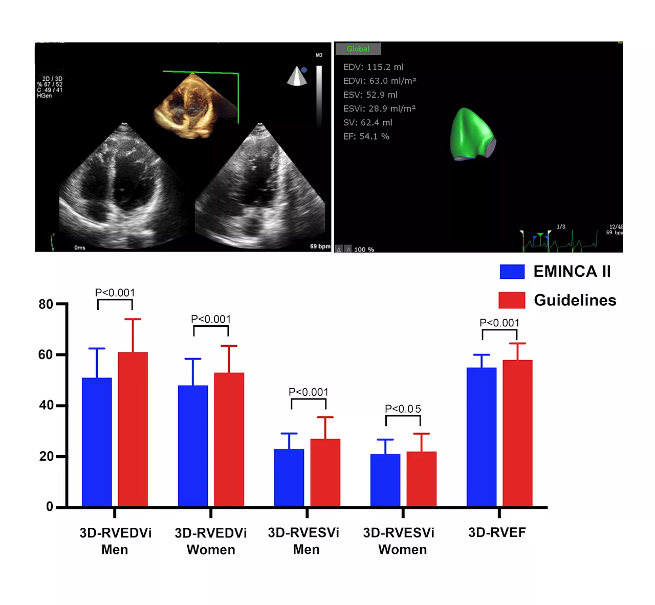Study reports normal values of 3D echocardiographic right ventricular volume established in Chinese adults