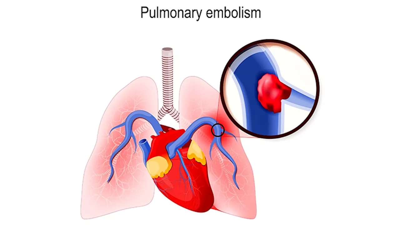 Mechanical Thrombolysis Effective in Pulmonary Embolism