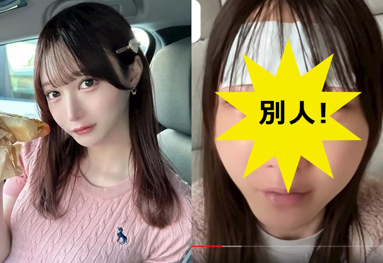 「顔面が変わってしまった…」美容施術したYouTuberが術後を公開、SNS衝撃も「誰かのためになれば」