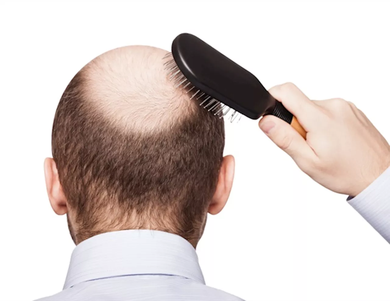 Microneedle patch holds promise for promoting hair regrowth caused by alopecia areata