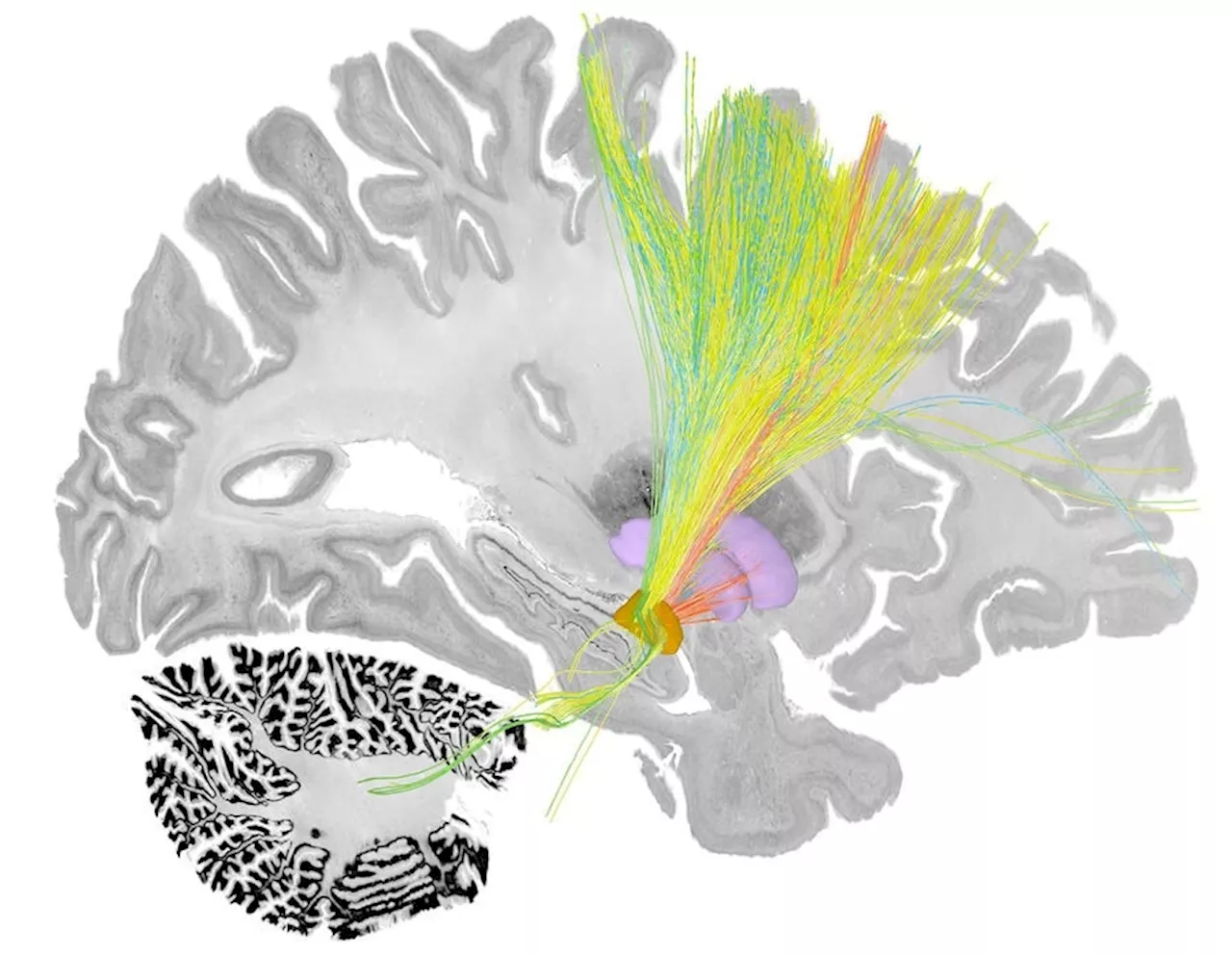 New algorithm enhances deep brain stimulation for Parkinson's by targeting specific symptoms