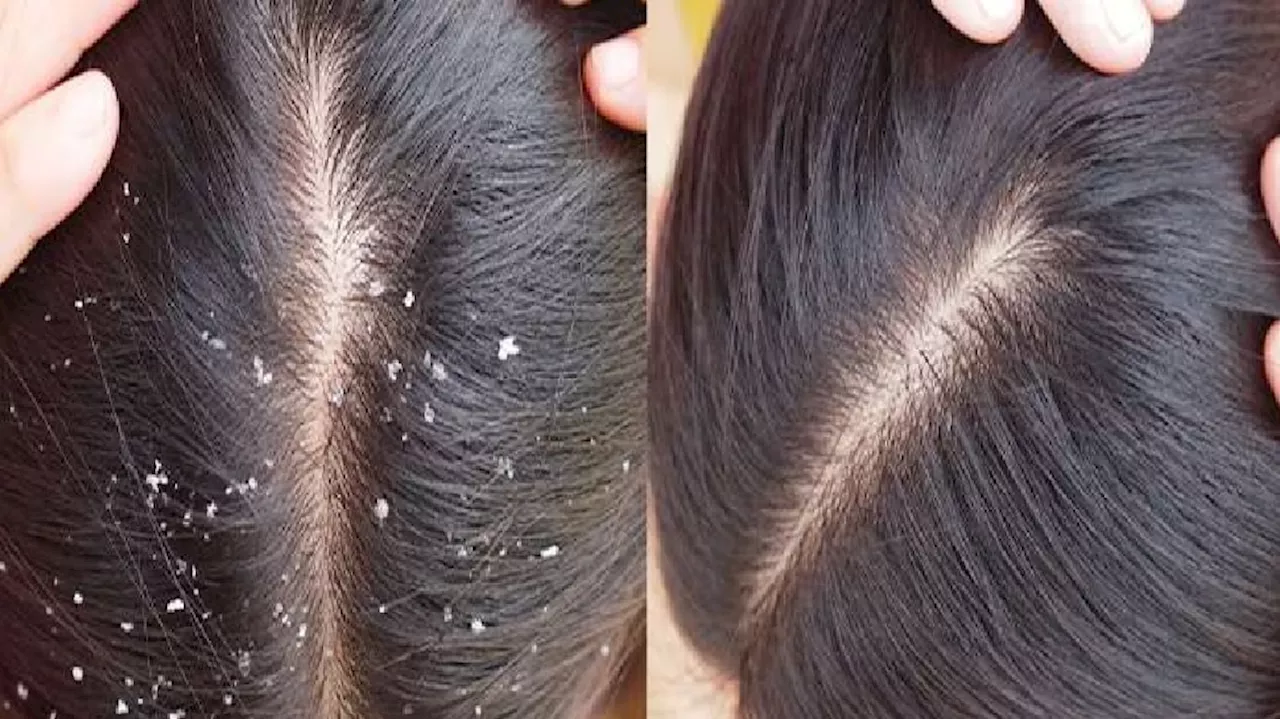 Dandruff: ತಲೆ ಹೊಟ್ಟಿನಿಂದ ಮುಕ್ತಿ ಪಡೆಯಲು ಈ ಸಿಂಪಲ್‌ ಸಲಹೆಗಳನ್ನು ಪಾಲಿಸಿ