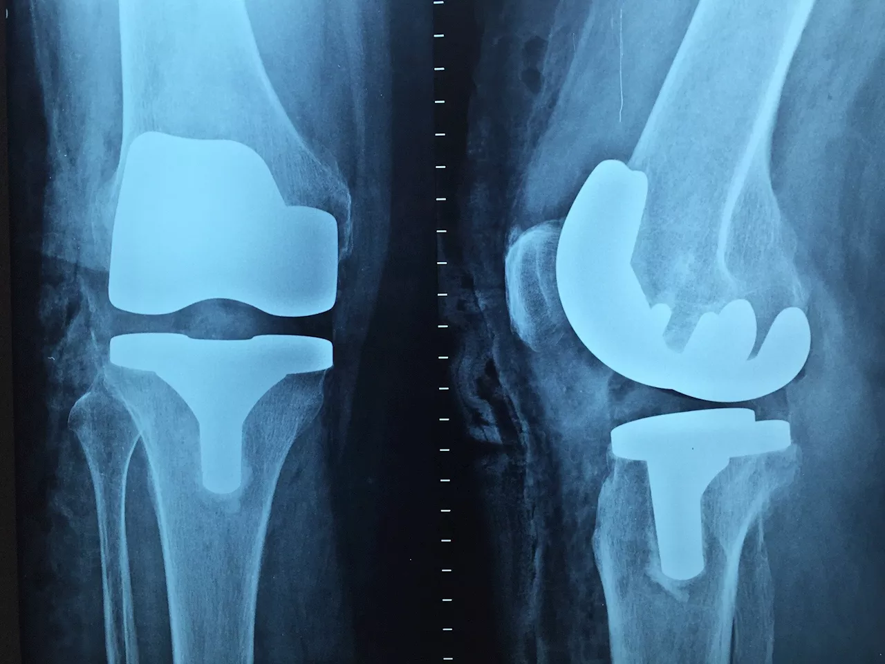 Lab values predict periprosthetic joint infection in patients with morbid obesity