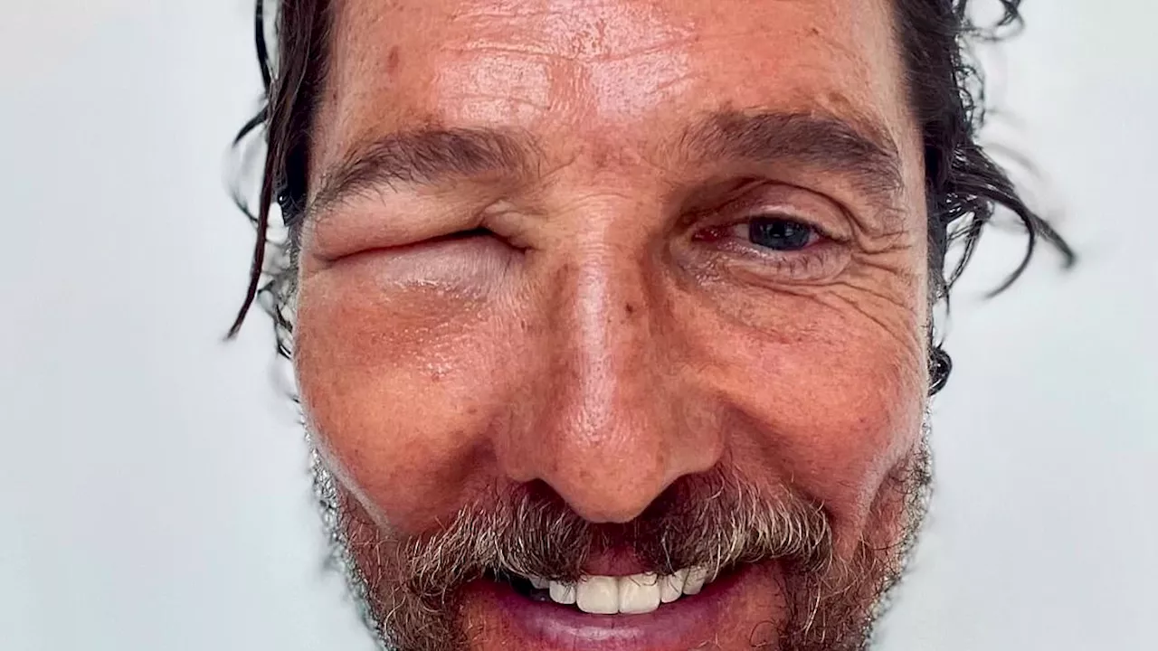 Matthew McConaughey shows off brutal bee sting leaving his right eye completely shut and swollen