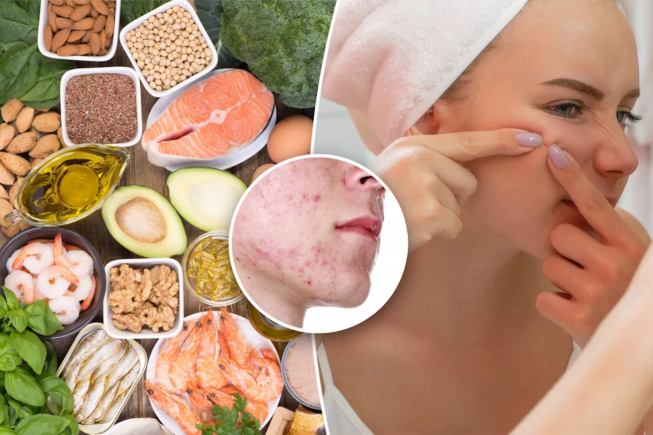 How a cheap supplement may help you finally get rid of that stubborn acne