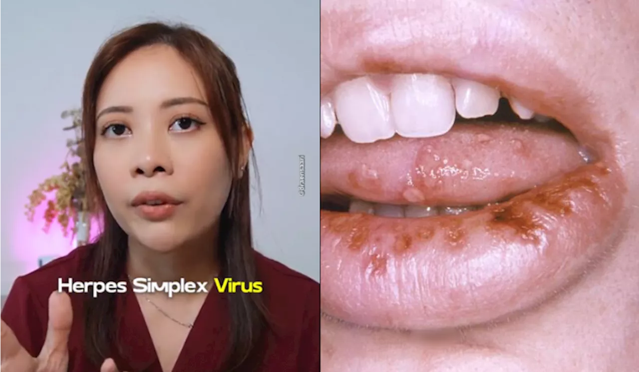 Doktor Kongsi Info Herpes, Boleh Berjangkit Secara Oral Jika Kongsi Barangan Makeup!