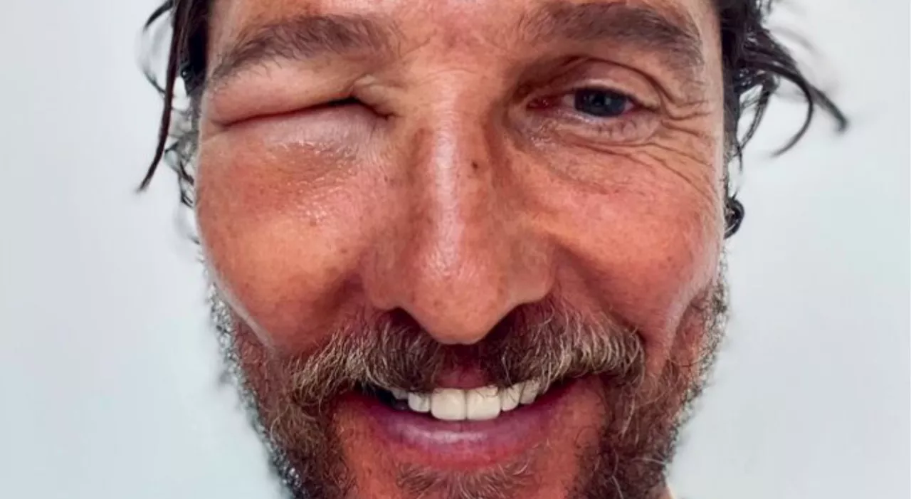 Matthew McConaughey con il volto tumefatto, la foto choc sui social. Utenti allarmati: «Stai bene?»