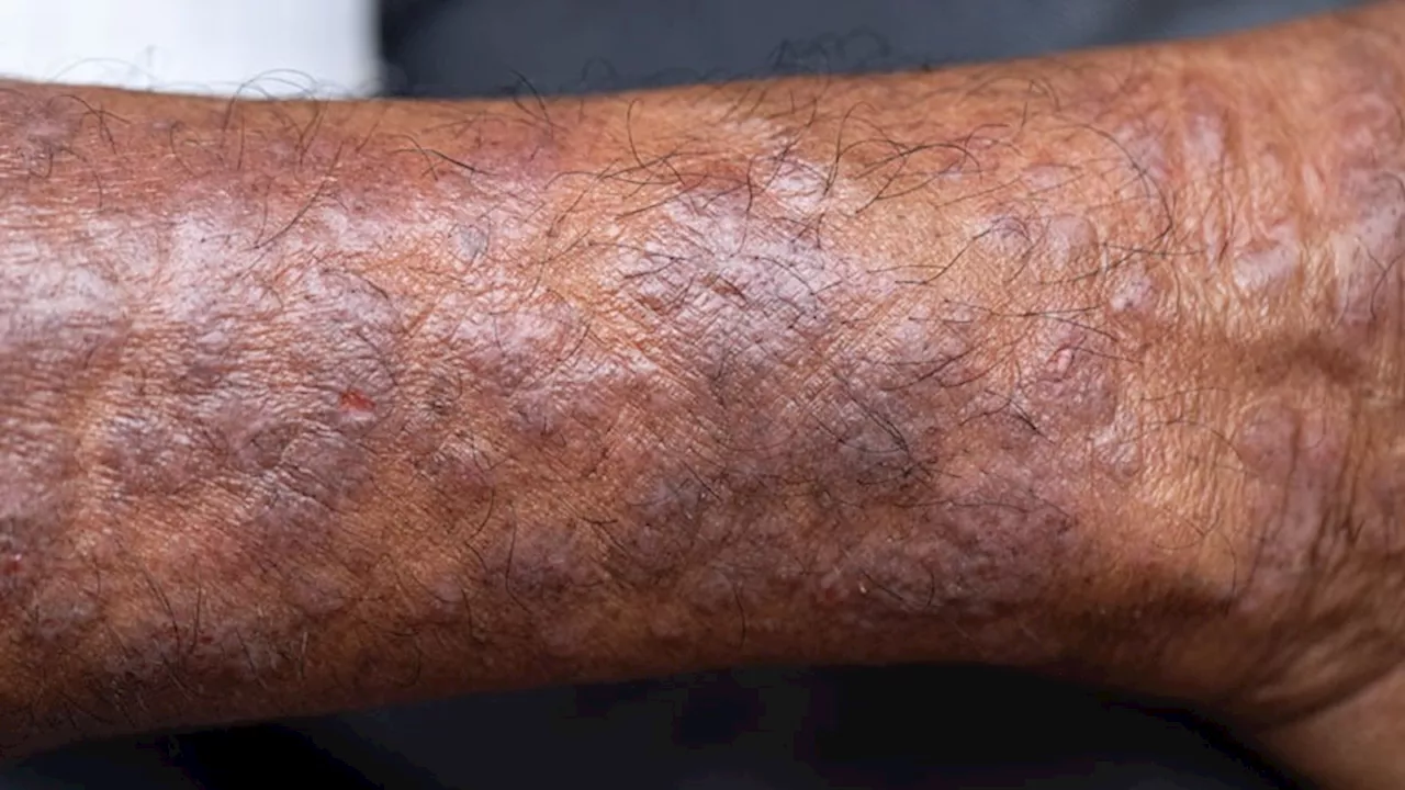 Atopic Dermatitis in Older Adults: Common, Unique, and Challenging to Manage