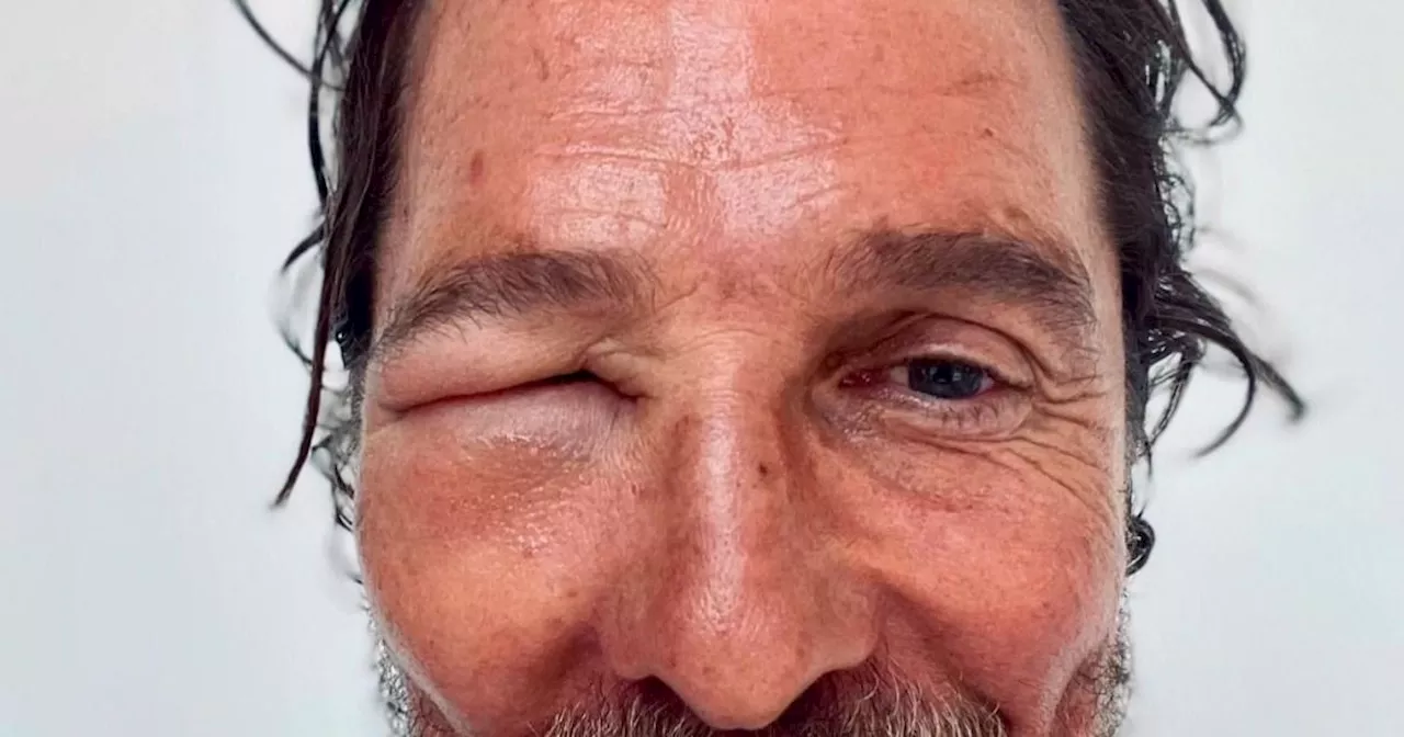 Matthew McConaughey's eye has fully closed over and it looks horrendous