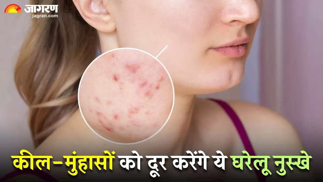 Home Remedies For Acne: इन घरेलू नुस्खों की मदद से करें पिंपल्स का सफाया, नहीं छूटेगा चेहरे पर एक भी दाग!