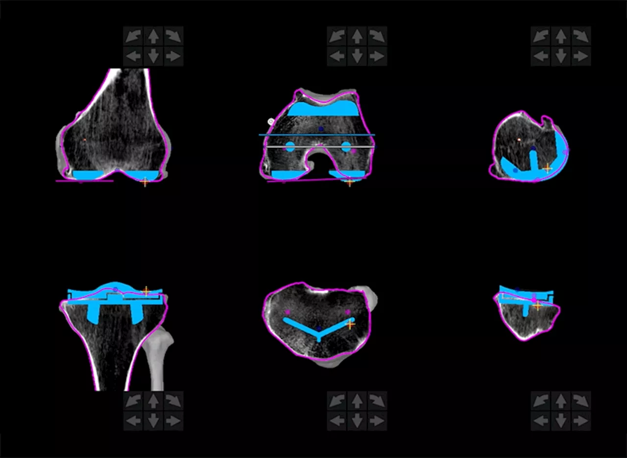 Robotic technology leads to personalized joint replacement surgery at Oberlin hospital