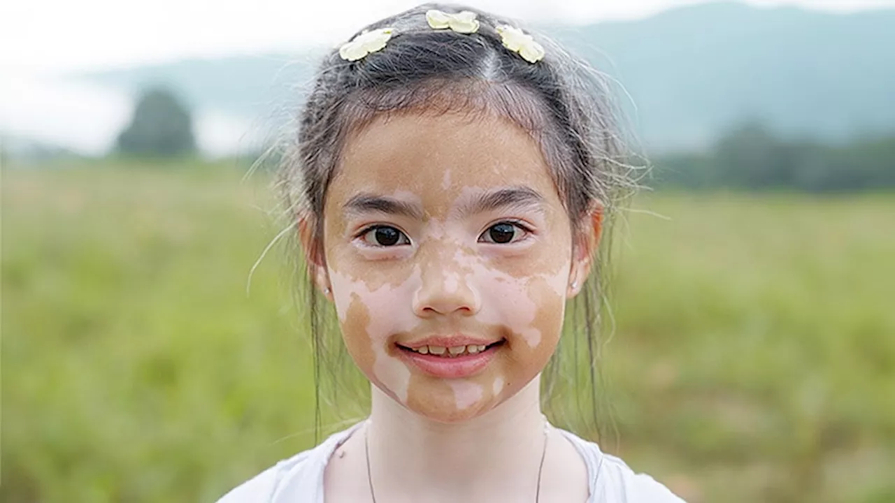 Adolescents With Vitiligo Achieve Higher Repigmentation Rates With Topical Ruxolitinib Than Adults