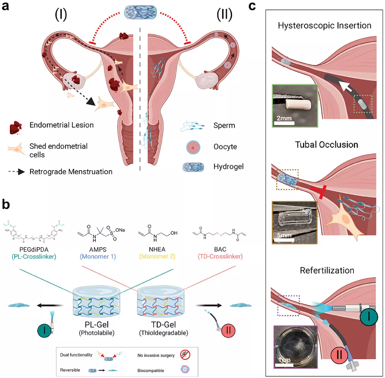 Researchers develop hydrogel implant to treat endometriosis